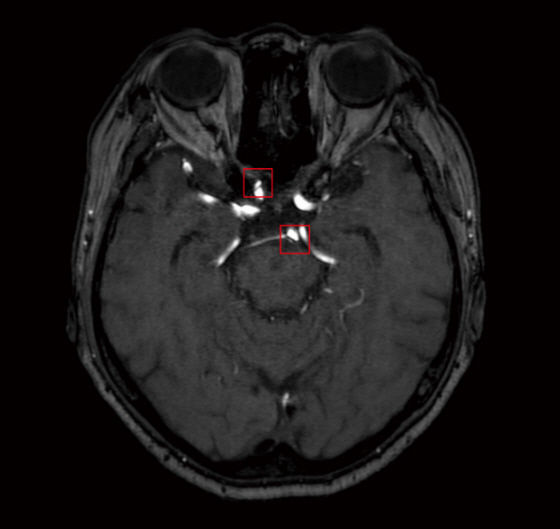 [서울=뉴시스] 딥뉴로는 뇌 MRA 영상에서 AI를 활용해 뇌동맥류를 검출해 의료진의 진단을 보조하는 솔루션이다.  사진은 딥뉴로 판독 이미지. (사진=딥노이드 제공) 2024.09.27. photo@newsis.com *재판매 및 DB 금지
