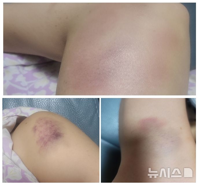 [창원=뉴시스] 강경국 기자 = 지난 5일 오전 경남 창원의 한 회원제 골프장에서 발생한 카트 추락 사고로 A(여·40대)씨의 왼쪽 어깨와 팔꿈치, 다리 등에 타박상을 입어 멍자국이 선명히 보인다. (사진=독자 제공). 2024.10.08. photo@newsis.com *재판매 및 DB 금지