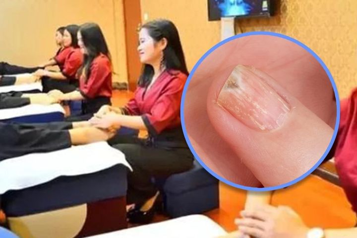[서울=뉴시스] 8일(현지 시각) 홍콩 사우스차이나모닝포스트(SCMP)는 4살 아들의 손톱 곰팡이 감염을 검증받지 않은 연고로 치료하려다 손가락 절단까지 이르게 한 중국 아버지의 사연을 보도했다. (사진=SCMP 보도 갈무리) *재판매 및 DB 금지