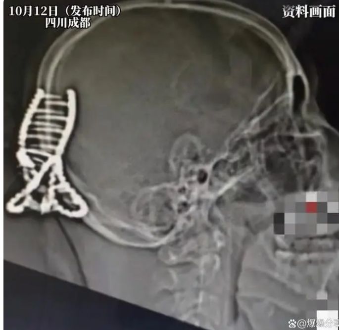 [서울=뉴시스]머리카락을 간편하게 고정할 수 있어 많은 사람이 사용하는 헤어 집게핀이 심각한 부상을 초래하는 일이 발생했다.(사진=BAIDU 갈무리) *재판매 및 DB 금지