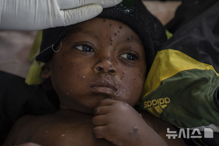 [AP/뉴시스] 지난 9월 초 콩고 동부 카미투가의 병원에서 엠폭스에 감염된 2살 어린이가 누워있다. 