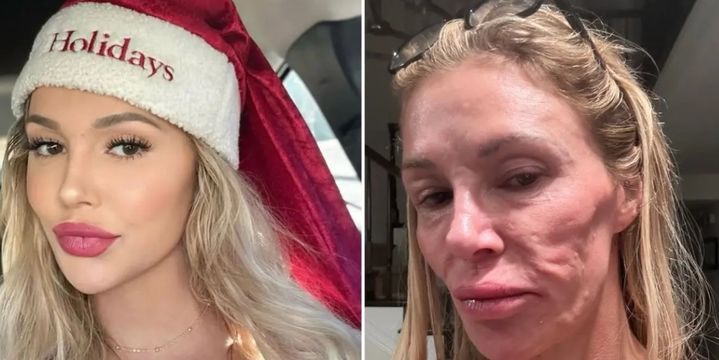 [서울=뉴시스]미국의 리얼리티 쇼에 출연한 스타가 기생충 때문에 자신의 얼굴이 망가졌다고 주장해 충격을 안겼다.(사진=브랜디 글랜빌 SNS) *재판매 및 DB 금지