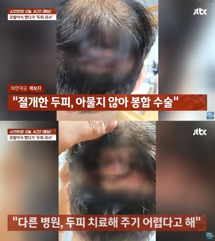 [서울=뉴시스] 유명 전문 병원에서 모발 이식 수술을 받았다가 두피가 괴사하는 등 부작용을 겪고 있다는 50대 남성의 사연이 전해졌다. (사진=JTBC '사건반장') *재판매 및 DB 금지