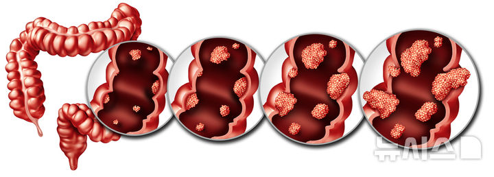 [서울=뉴시스]복강경 수술에 부적합한 대장암 환자가 무리해서 복강경 수술을 받다가 개복 수술로 전환하게 되면 합병증 발생률이 2배 가까이 증가할 수 있다는 연구 결과가 나왔다. (사진= 게티이미지뱅크 제공) 2024.12.26. photo@newsis.com. 
