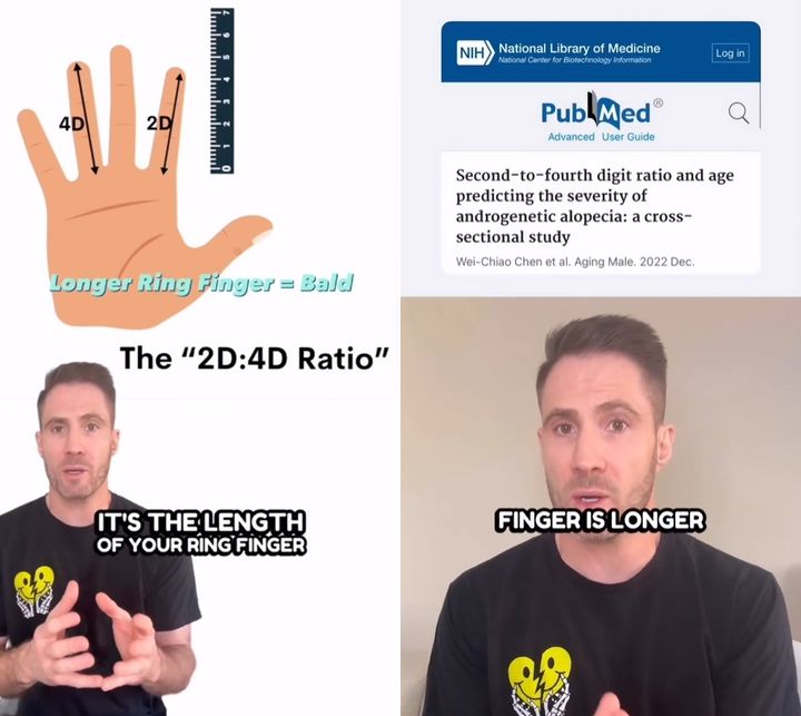 [서울=뉴시스] 약지가 검지보다 길수록 남성형 탈모 발생 가능성이 더 높다는 주장이 제기됐다. (사진=인스타그램) *재판매 및 DB 금지
