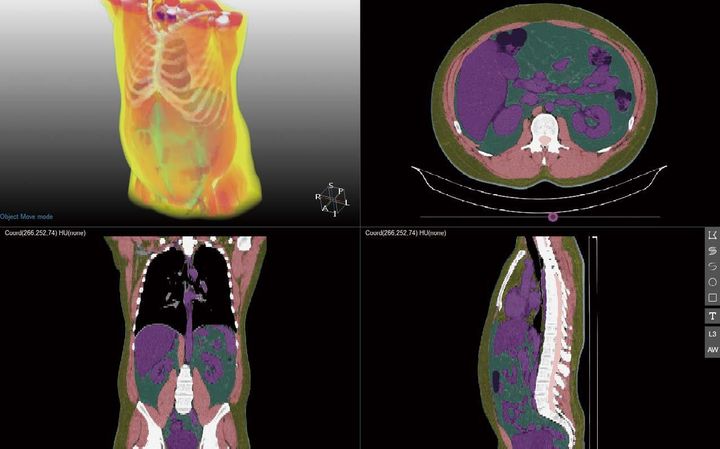 [양산=뉴시스] CT 촬영 시 딥캐치 소프트웨어를 반영한 이미지. (사진=양산부산대병원 제공) 2025.01.01. photo@newsis.com *재판매 및 DB 금지