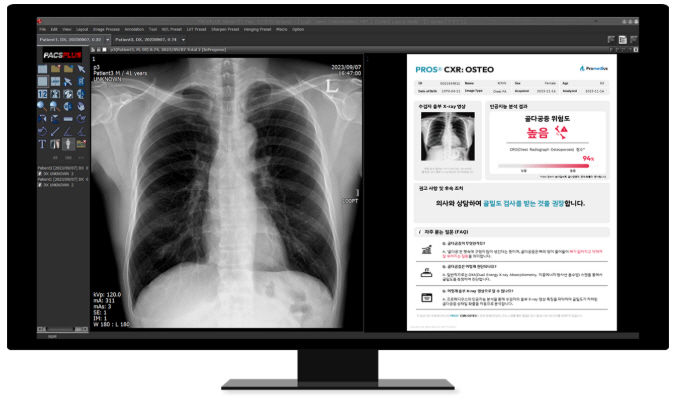 [서울=뉴시스] 프로메디우스는 인공지능(AI) 기술로 골다공증 의심 여부를 확인할 수 있는 선별 및 진단보조 소프트웨어 '프로스 CXR: 오스테오(PROS® CXR: OSTEO)'를 개발했다. (사진=프로메디우스 제공) 2025.01.03. photo@newsis.com *재판매 및 DB 금지