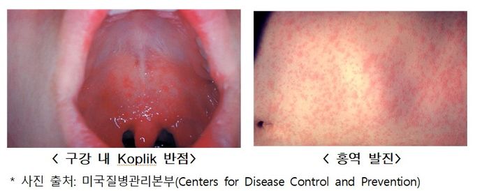 [세종=뉴시스] 홍역(사진=질병관리청) *재판매 및 DB 금지