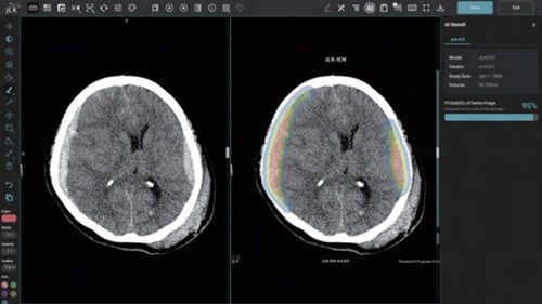 제이엘케이 뇌출혈 검출 솔루션 JLK-ICH. (사진=제이엘케이 제공) *재판매 및 DB 금지