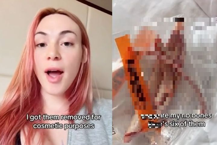 갈비뼈 6개를 제거한 미국의 트랜스젠더 여성 에밀리 제임스(왼쪽)와 수술로 제거한 그의 갈비뼈 (출처=뉴욕포스트) *재판매 및 DB 금지