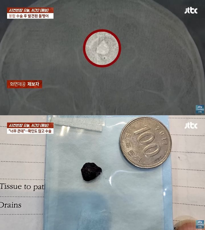 [서울=뉴시스] 아스팔트 도로에서 넘어져 이마를 다친 남성이 병원에서 봉합수술을 받았는데 의사가 박힌 1cm 크기의 돌을 빼지 않고 그대로 꿰맸다는 황당한 사연이 전해졌다. (사진=JTBC '사건반장') *재판매 및 DB 금지
