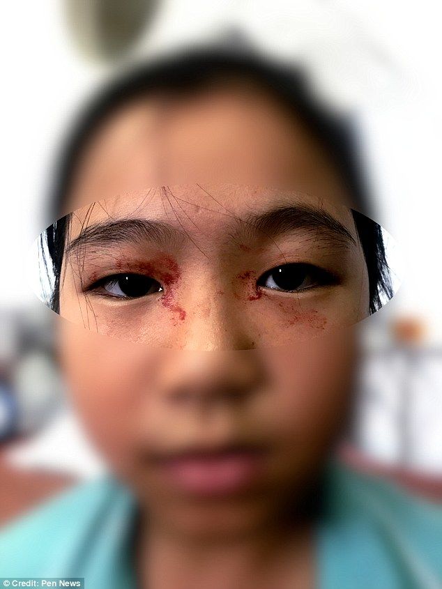 [서울=뉴시스]이탈리아의 21세 여성이 상처가 없는데도 얼굴과 손바닥에서 출혈이 발생하는 희귀 질환을 경험했다.(사진=Pen News) *재판매 및 DB 금지