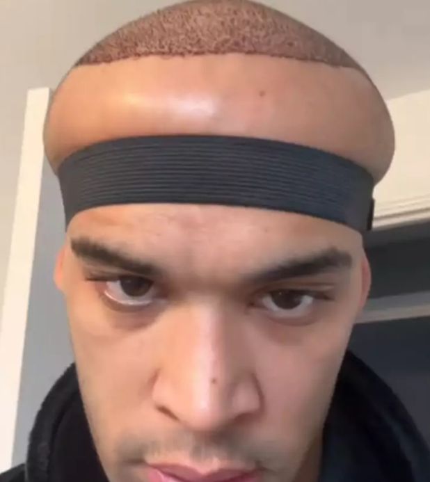 [서울=뉴시스]모발 이식 수술 후 부작용으로 머리가 부풀어 오른 남성이 있어 화제다.(사진=래드바이블) *재판매 및 DB 금지