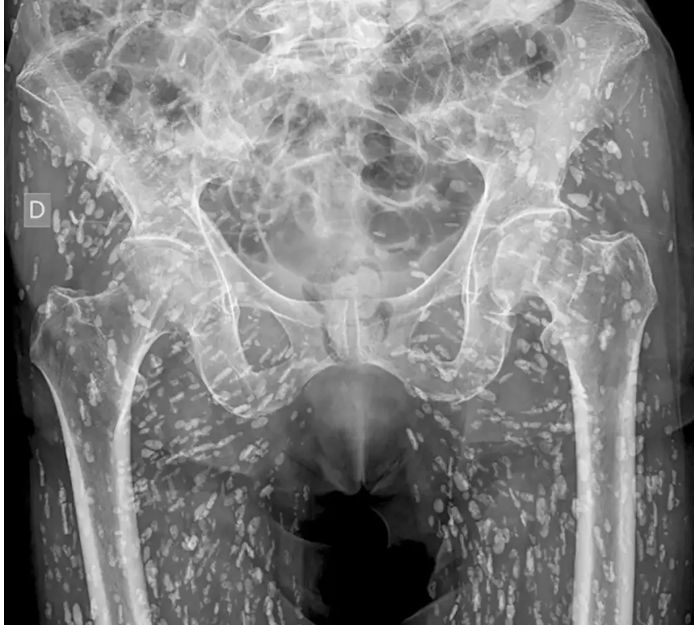 [서울=뉴시스]엉덩이뼈 골절로 촬영한 엑스레이에서 엉덩이와 다리 부위에 수백 개의 기생충 알이 발견된 남성의 충격적인 사연이 전해졌다.(사진=뉴욕포스트) *재판매 및 DB 금지