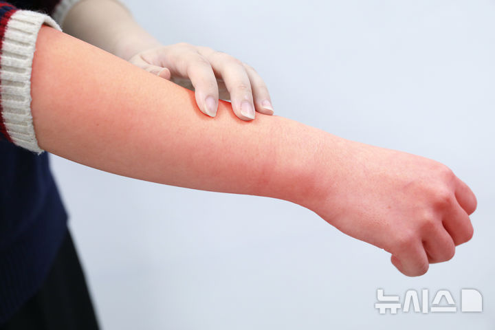 [서울=뉴시스]전신 홍반성 루푸스(Systemic Lupus Erythematosus, SLE)는 대표적인 만성 자가면역 질환이다. 주로 30~40대 젊은 여성을 집중적으로 공격한다. '천의 얼굴'을 가진 병이라 불릴 정도로 증상이 다양해 맞춤형 치료가 중요하다. (사진은 실제 루푸스 병변은 아님)(사진= 고려대 안산병원 제공) 2025.02.13. photo@newsis.com. 