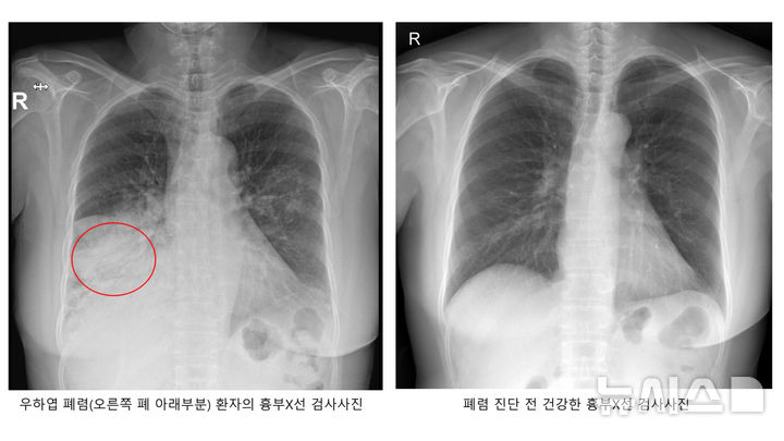 [서울=뉴시스]폐렴 환자의 흉부 X선 사진. (사진= 서울성모병원 제공) 2025.02.17 photo@newsis.com. 