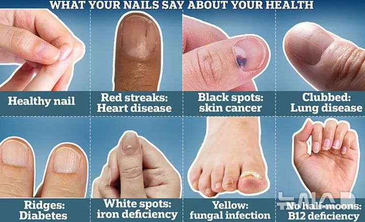 [서울=뉴시스] 손톱의 모양이나 상태를 통해 건강 이상의 징후 등을 발견할 수 있다. (사진=데일리메일)