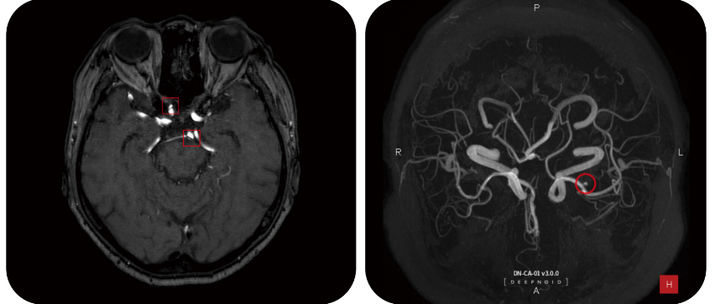 [t서울=뉴시스] 딥노이드는 내달 5일부터 3일간 개최되는 일본 의료 산업 전시회 ‘메디컬 재팬 오사카 2025 (Medical Japan OSAKA2025)’에 부스 참여한다고 25일 밝혔다. 사진은 딥뉴로 판독 화면. (사진=딥뉴로 제공) 2025.02.25. photo@newsis.com *재판매 및 DB 금지