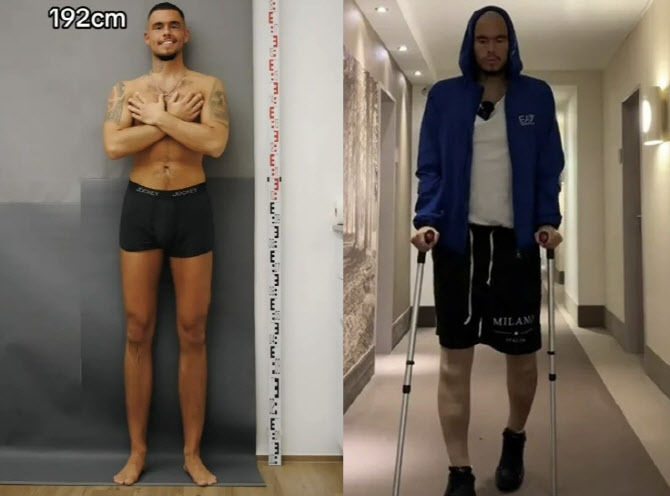 [서울=뉴시스] 작은 키 때문에 놀림 받던 미국의 20대 남성이 사지연장술을 받아 키가 20.5㎝ 늘어난 사연이 전해져 화제다. (사진= 더선 캡처 ) 2025.03.02. photo@newsis.com *재판매 및 DB 금지