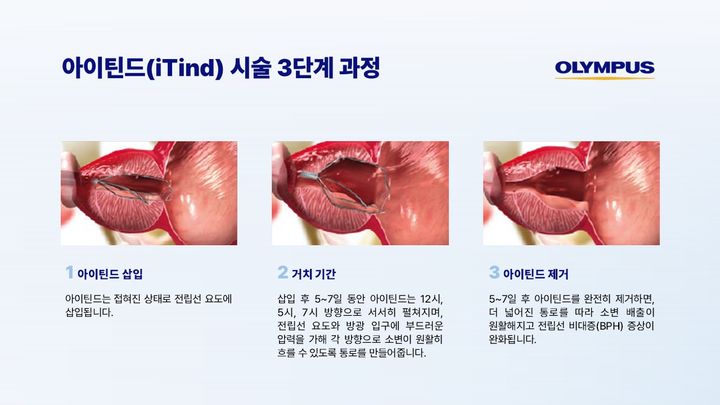 [서울=뉴시스] 4일 글로벌 의료기업 올림푸스한국은 전립선비대증 환자 치료를 위한 최소침습적 해법인 '아이틴드(iTind)'를 국내에 출시한다고 밝혔다. (사진=올림푸스한국 제공) 2025.03.04. photo@newsis.com *재판매 및 DB 금지