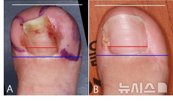 [서울=뉴시스]연부조직 절제 후 발톱 폭의 비율을 이미지 분석 방식을 통해 분석한 결과, 수술 전 (A)와 같이 발톱 폭이 좁았던 상태에서 수술 후 (B)와 같이 발톱 폭의 비율이 최대 52.52%까지 개선되는 것을 확인했다.(사진= 세브란스병원 제공) 2025.03.06. photo@newsis.com. 