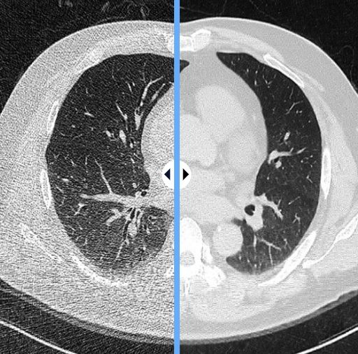 [서울-뉴시스] 8일 클라리파이에 따르면 서울대어린이병원 연구팀은 클라리파이가 개발한 의료AI 솔루션 'ClariCT.AI'를 활용한 결과 초저선량 CT에서도 영상 품질이 일반 선량 CT와 유사하고 진단 성능 또한 유지할 수 있다고 보고했다. 사진은 클라이파이의 의료AI 솔루션 사용 전(왼쪽)과 후 모습. (사진=클라리파이 제공) 2025.03.07. photo@newsis.com *재판매 및 DB 금지