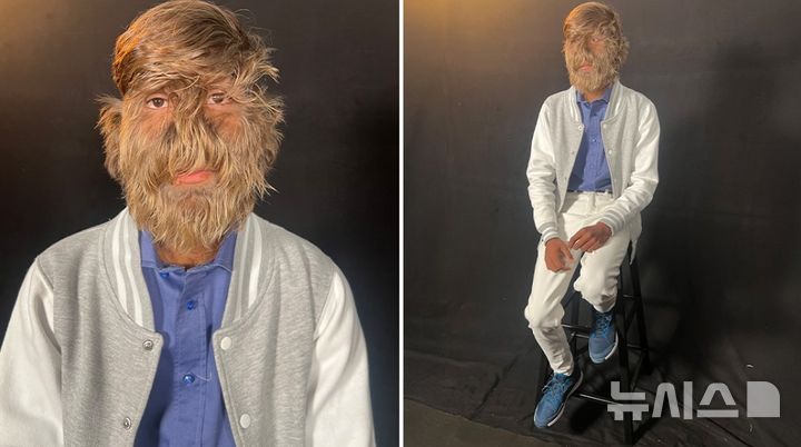 [서울=뉴시스] 인도의 18세 소년 라리트 파티다르가 세계에서 얼굴 털이 가장 많은 사람으로 기네스북에 올랐다 (사진=기네스북 홈페이지)