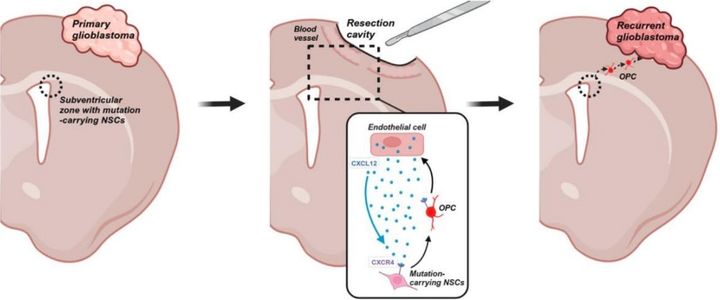 [서울=뉴시스] 12일 의료계에 따르면서울대병원, 연세암병원, 한국과학기술원 공동 연구팀은 교모세포종 재발의 근원이 뇌실하지역에 있는 신경줄기세포(NSCs)에서 비롯될 수 있음을 밝혀냈다. (사진=서울대병원 제공) 2025.03.12. photo@newis.com&nbsp; *재판매 및 DB 금지