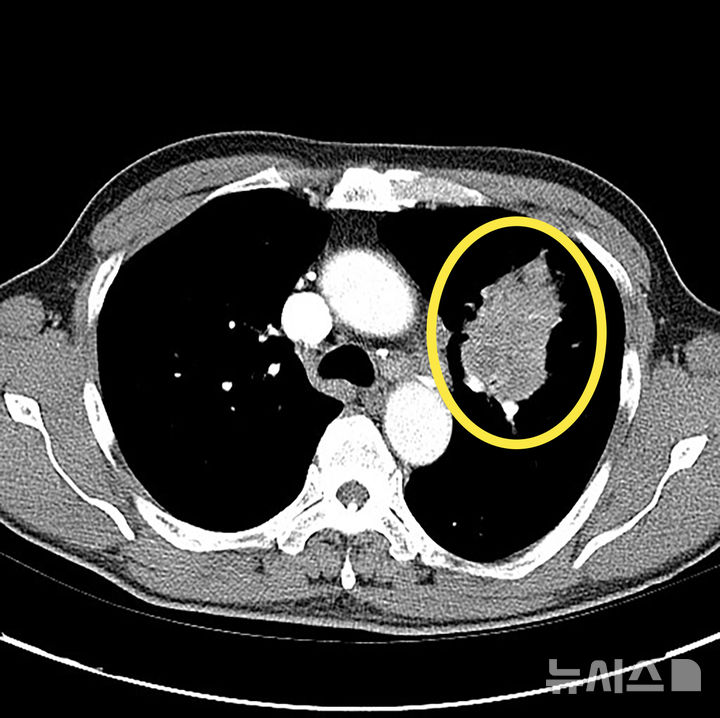"담배도 안 피우는 데 폐암이라고?"…위험 요인은 '이것'
