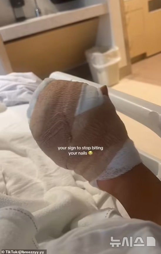 [서울=뉴시스] 한 캘리포니아 여성은 병원에 입원해 사람들에게 손톱을 물어뜯지 말라고 경고했다. (사진=데일리메일) 