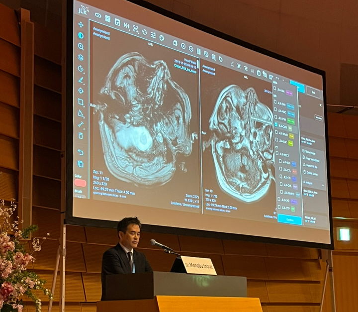일본 국립뇌심혈관센터 이노우에 마나부 교수가 지난 달 일본 오사카에서 개최된 STROKE 2025 JAPAN에 참여해 일본 의료진을 대상으로 JLK 뇌졸중 AI 솔루션 적용 사례를 발표하고 있다. (사진=제이엘케이 제공) *재판매 및 DB 금지