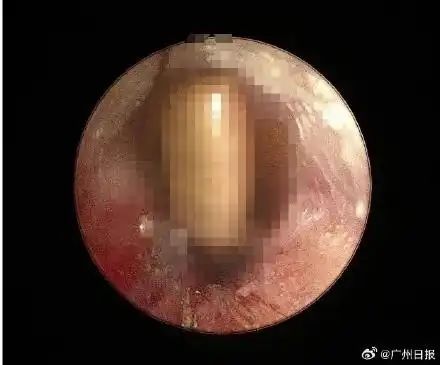 [서울=뉴시스] 귓속으로 기어 들어간 바퀴벌레. (사진=바이두) *재판매 및 DB 금지