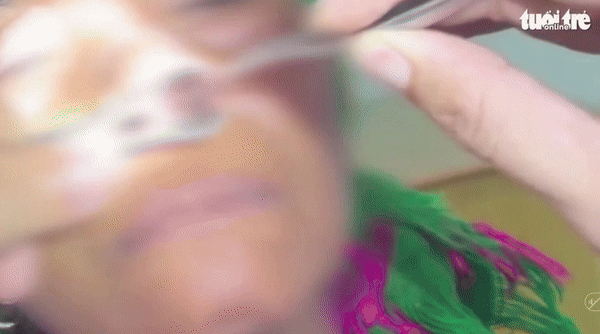 베트남에서 한 여성의 코에 6cm가 넘는 거머리가 발견돼 충격을 주고 있다.(사진=Nguoi Dua Tin) *재판매 및 DB 금지