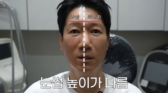 리프팅 시술한 59살 지석진 "효과 이 정도였냐"