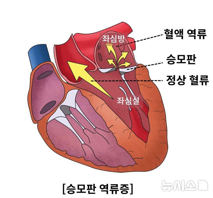 [서울=뉴시스]퇴행성 승모판 역류증은 노화로 인해 좌심방에서 좌심실로 가는 입구에 위치한 승모판이 완전히 닫히지 않아 좌심실이 수축할 때 혈액이 좌심방으로 역류하는 질환이다. (이미지= 서울아산병원 제공) 2025.04.21. photo@newsis.com.