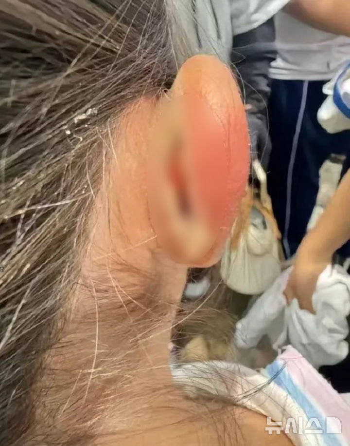 [서울=뉴시스]귀가 찢어진 학생의 모습. (사진=화상보대풍신문) 