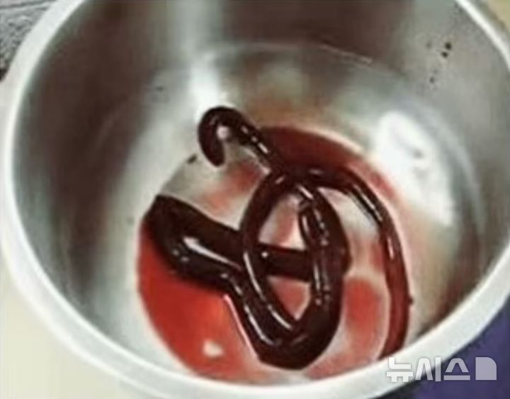 [서울=뉴시스] 인도의 한 30대 남성의 방광에서 길이 30cm에 달하는 붉은 기생충이 발견됐다. (사진=학술지 ‘임상 및 진단 연구 저널’)