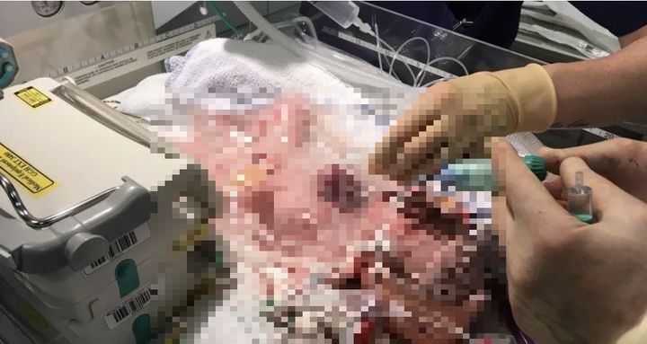 [서울=뉴시스] 심장이 몸 밖으로 튀어나오는 '심장이소증'을 앓고도 기적적으로 생존한 한 소녀가 최근 성공적으로 수술을 마쳤다. (사진=글렌필드병원) 2025.05.02 *재판매 및 DB 금지