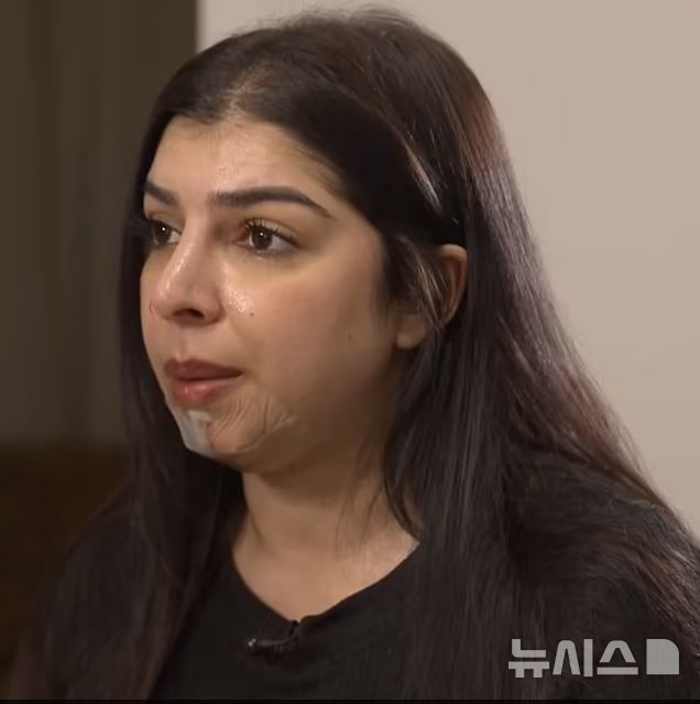 [서울=뉴시스] 영국의 한 여성이 필러 시술 후 피부 혈관이 막히는 심각한 부작용을 겪은 사연이 공개됐다. (사진=데일리메일)