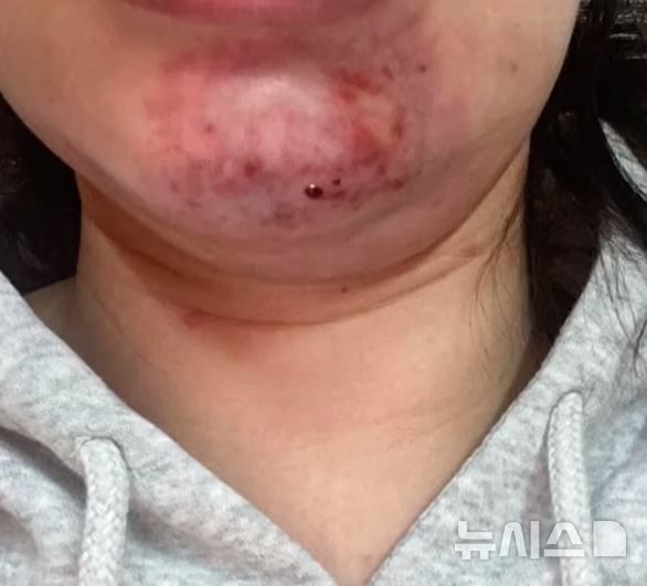 [서울=뉴시스] 상황이 점점 악화되자 마리엄은 다른 병원을 찾아갔고, 그곳에서 필러가 혈관을 막아 발생한 '혈관 폐색'이라는 진단을 받았다. (사진=데일리메일)