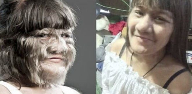 [서울=뉴시스] 온몸이 털로 뒤덮이는 희귀병을 앓아 '세계에서 가장 털이 많은 10대'로 기네스북에 등재됐던 수파트라 서스판(25)의 달라진 근황이 공개됐다. (사진=@Oluwanisurest16 엑스 캡처) 2025.05.12 *재판매 및 DB 금지