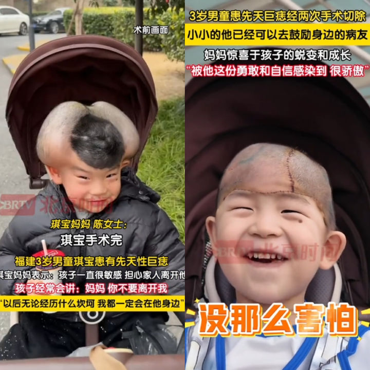 [서울=뉴시스] 선천성 거대 모반증을 앓고 있던 소년이 6시간에 걸친 대수술을 성공적으로 마쳤다. (사진 = 틱톡 캡처) 2025.05.19. *재판매 및 DB 금지