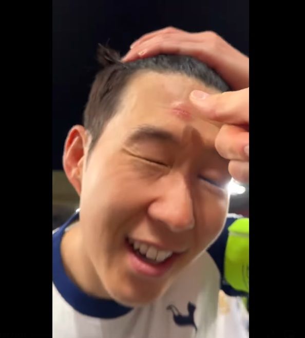 [서울=뉴시스]손흥민 영광의 상처. (사진=토트넘 소셜미디어 영상 캡처) 2025.05.21. photo@newsis.com *재판매 및 DB 금지