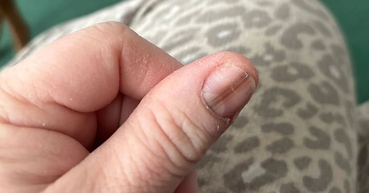 [서울=뉴시스] 미국의 한 여성이 틱톡 영상을 보고 병원을 찾아갔다가 손발톱하흑색종 진단을 받았다. (사진 = SWNS 캡처) 2025.05.22. *재판매 및 DB 금지