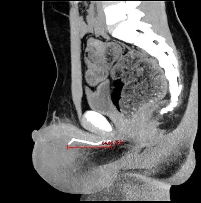[서울=뉴시스]중국의 한 10세 소년이 하체 통증으로 병원을 찾았다가 몸속에서 7cm 길이의 철사가 발견돼 충격을 주고 있다.(사진=장강일보) *재판매 및 DB 금지