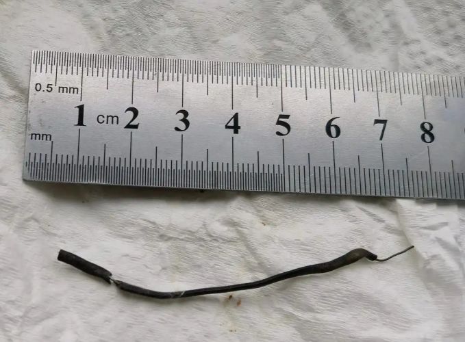 [서울=뉴시스]중국의 한 10세 소년이 하체 통증으로 병원을 찾았다가 몸속에서 7cm 길이의 철사가 발견돼 충격을 주고 있다.(사진=장강일보) *재판매 및 DB 금지