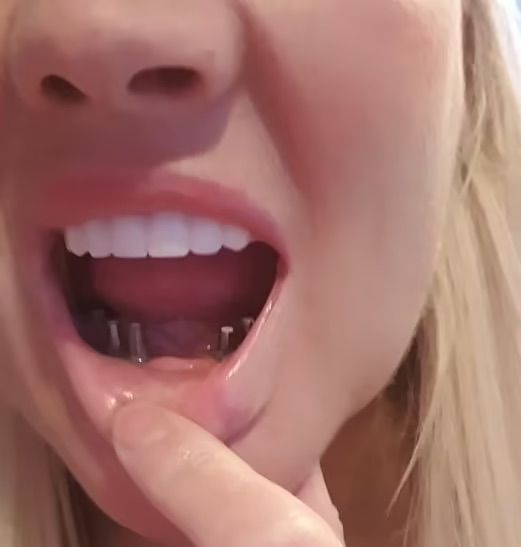 [뉴시스]영국의 한 여성이 저렴한 시술비용에 이끌려 튀르키예에서 치과 치료를 받았는데, 이후 얼굴이 심각하게 붓는 등 끔찍한 후유증을 겪고 있다는 사연이 전해졌다. (사진=틱톡) *재판매 및 DB 금지