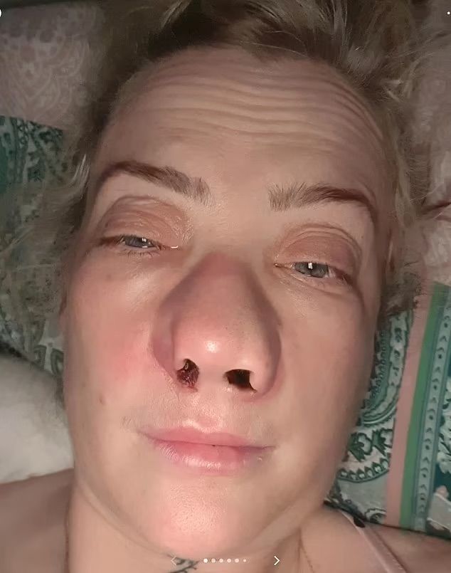 [뉴시스]영국의 한 여성이 저렴한 시술비용에 이끌려 튀르키예에서 치과 치료를 받았는데, 이후 얼굴이 심각하게 붓는 등 끔찍한 후유증을 겪고 있다는 사연이 전해졌다. (사진=틱톡) *재판매 및 DB 금지