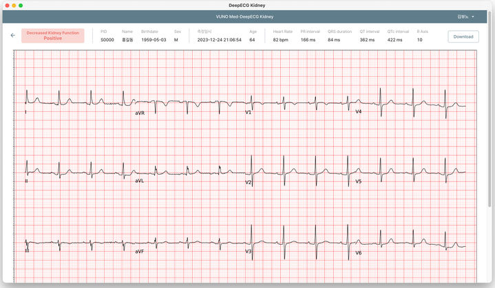 [서울=뉴시스] 의료 인공지능(AI) 기업 뷰노는 AI 기반 콩팥기능 저하 선별 심전도 분석 소프트웨어 뷰노 메드-딥 ECG Kidney의 식약처 의료기기 허가를 획득했다고 9일 밝혔다. (사진=뷰노 제공) 2025.06.09 photo@newsis.com *재판매 및 DB 금지
