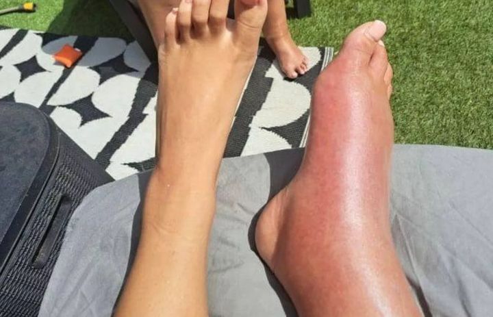 [서울=뉴시스] 영국 버밍엄에 거주하는 케이틀랜드 라이트(26·여)는 혈전 초기 대응에 실패해 다리가 크게 부어올랐다. (사진=버밍엄라이브 캡처) 2025.06.16 *재판매 및 DB 금지